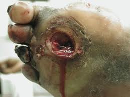 MRSA 5